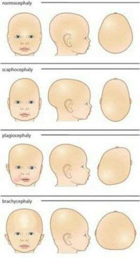 Plagiocephaly Pediatric Physical Therapy Torticollis Baby Helmet