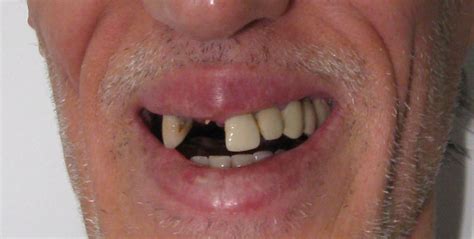 Il figure parmi les solutions qui vous aideront à retrouver le sourire ! Implant Alpha-Bio - Europa Dental France