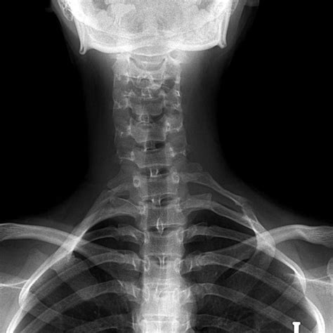 Simple X Ray Shows 16 Years Old Women With Bilateral Cervical Ribs