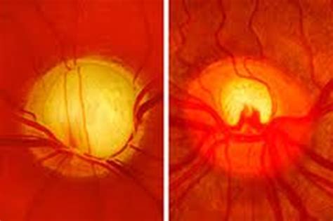 Best Cataract Eye Drops Glaucoma Non Carnosine C Anatomi