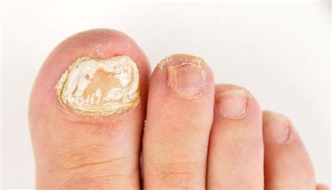Fungal Nails Routine Nail Care Athletes Foot Dermatology Bexley