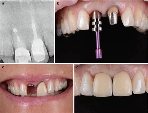 Restoration Of The Endodontically Treated Tooth Pocket Dentistry