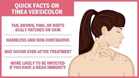 Tinea Versicolor Causes Treatment And Natural Remedies