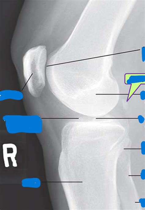 Lateral Knee Anatomy Diagram Quizlet