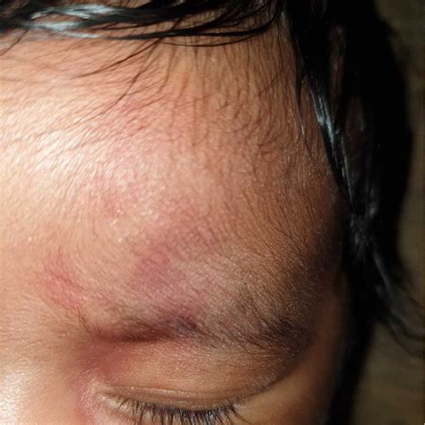 Baby Gets Red Patches On Her Forehead Firstcry Parenting