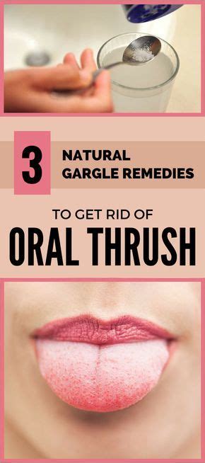 3 Natural Gargle Remedies To Get Rid Of Oral Thrush Oral Thrush