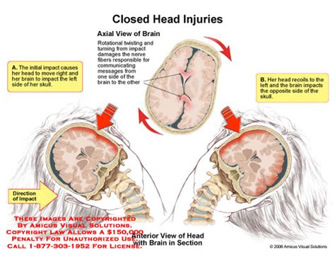 AMICUS Illustration Of Amicus Injury Closed Head Injuries Brain Skull