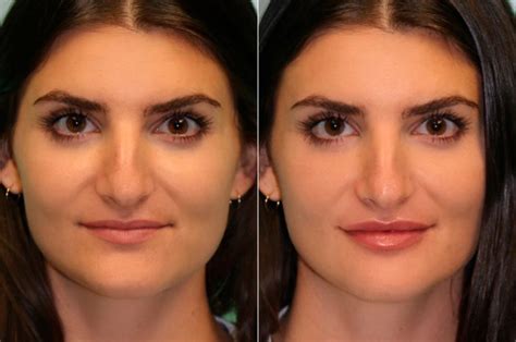 Lip Augmentation Photos Chevy Chase Md Patient 15113