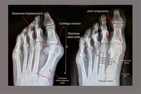 Bunion X Ray Before After