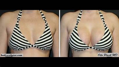 Boob Breast Cc Augmentation Job Boobs