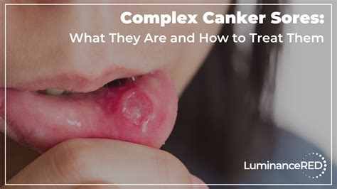 Complex Canker Sores What They Are And How To Treat Them Youtube