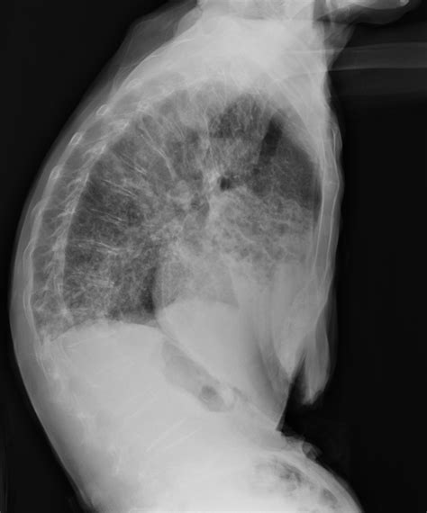 Pulmonary Mycobacterium Avium Complex Infection Image