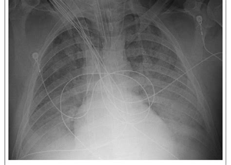Hospital Day 1 Anterior Posterior Chest X Ray Demonstrating Widespread