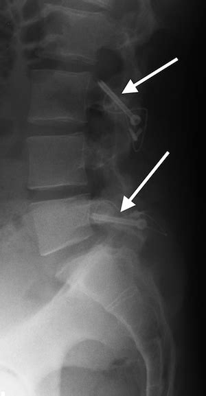 Surgical Repair Of Pars Interarticularis Fractures Spine Surgeon