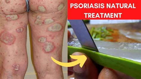 Home Remedies For Psoriasis 3 Proven Natural Treatments Youtube