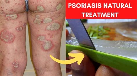 Home Remedies For Psoriasis (3 Proven Natural Treatments) - YouTube