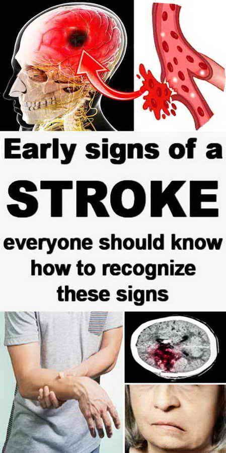 Early Signs Of Stroke Every Man Or Woman Should Know These Signs Stroke Symptoms Stroke