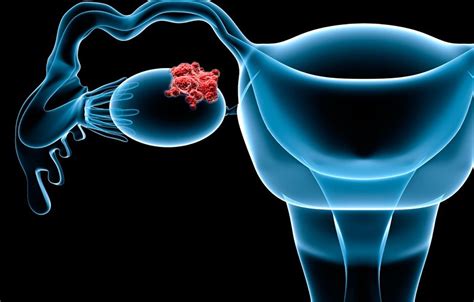 However, several factors may increase a woman's risk for ovarian cancer, including if you— PARP Inhibitor Shows Benefit in Ovarian Cancer | Clearity ...
