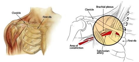Thoracic Outlet Syndrome Symptoms Total Health Systems