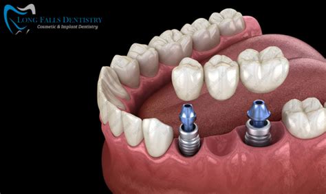 Everything You Need To Know About Abutment Teeth Long Falls Dentistry