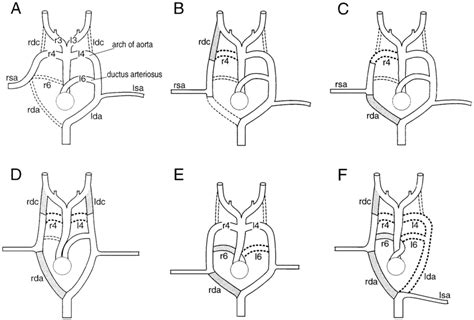 Schematic Representations Of Aortic Arch Malformations In Ece 1 Or Et