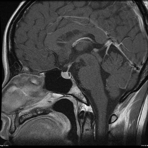 Normal Pituitary With Tiny Rathkes Cleft Cyst Image