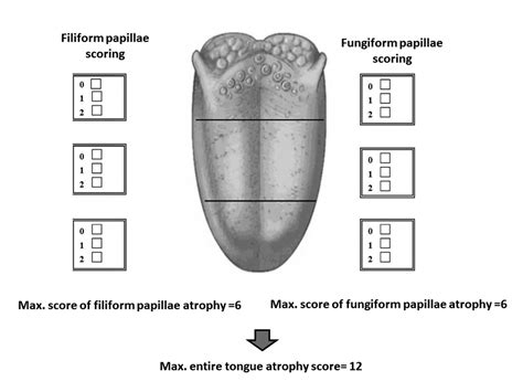 Tongue Atrophy In Sjögren Syndrome Patients With Mucosa Associated
