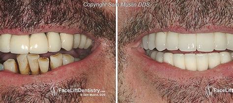 Nushield is available in a wide range of shapes & sizes. Graft Tooth And Extraction Bone Pain