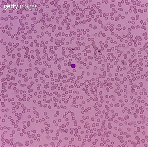 Acute Promyelocytic Leukemiaapl Apml Blast Cells A Type Of Blood