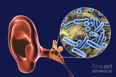 Otitis Media Ear Infection Photograph By Kateryna Konscience Photo