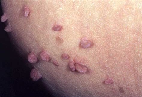 Skin Tags Symptoms Causes And Other Risk Factors