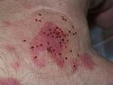 Pictures of Bed Bug Spray Effects On Humans
