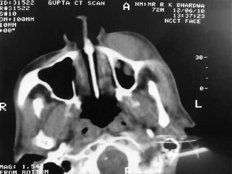 Computed Tomography Scan Revealing A Soft Tissue Lesion On The Left