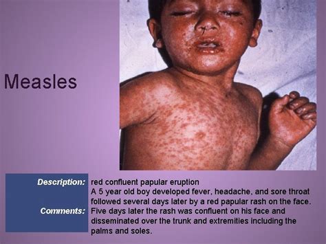 Common Pediatric Rashes Discussion Outline Dermatology Terminology Common