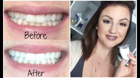 How To Get Super White Teeth Easy And Cheap ♡ Youtube