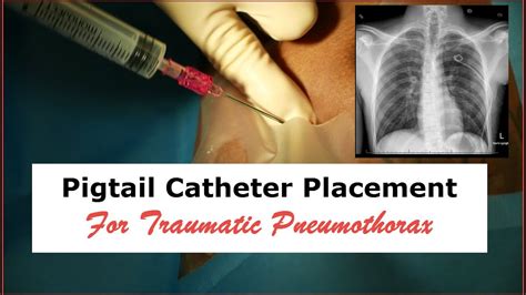 Pigtail Catheter Placement For Traumatic Pneumothorax Youtube