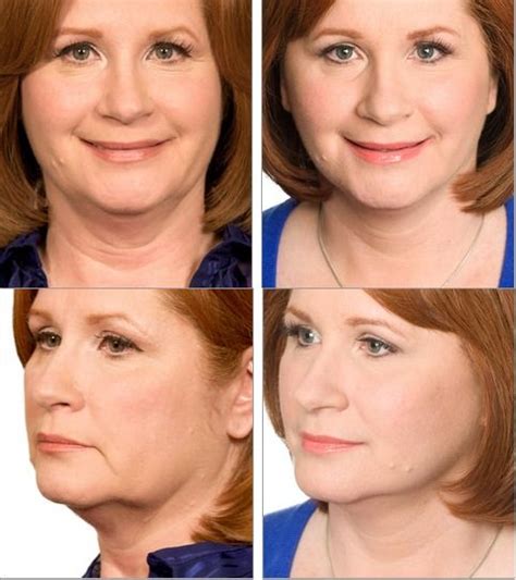 Shutterstock address saggy jowls and chicken neck Sagging neck and jowls- Sherrie, age, 55 had the Lifestyle Lift face and neck firming procedures ...