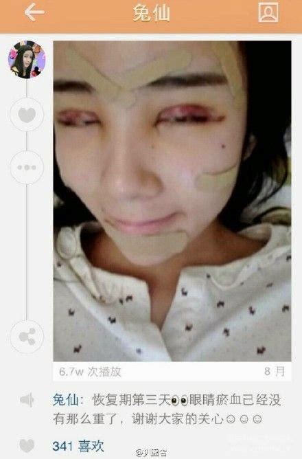 GALERI Gadis 15 Tahun Lee Hee Danae Selepas Pembedahan Plastik Ekstrem