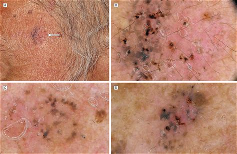 The “signature” Pattern Of Multiple Basal Cell Carcinomas Dermatology