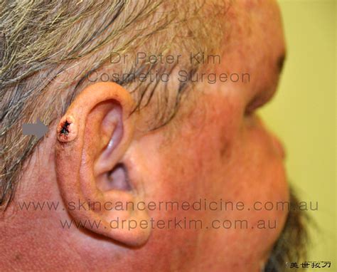 Bcc Ear Basal Cell Carcinoma Of The Ear Skin Is Yours For Flickr