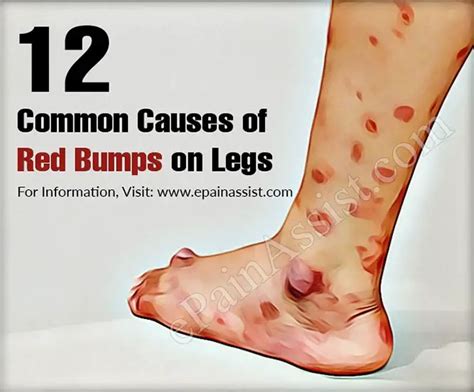 Reasons For Red Spots On Legs Ny