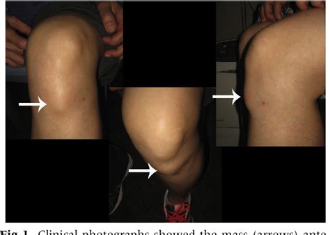 Figure 1 From Endoscopic Resection Of Lipoma Of The Patellar Tendon