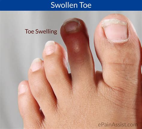 Swollen Toe Or Toe Swelling Causessymptomstreatment