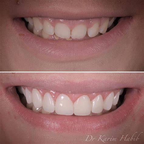 Composite Veneers Sydney Dental Bonding Sydney Dentist Ryde