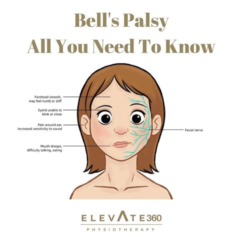 Bell S Palsy All You Need To Know Elevate Physiotherapy