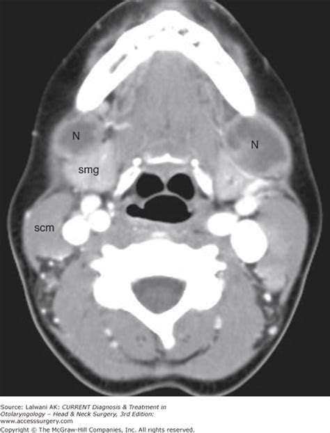 Head And Neck Ct Scan Of Neck Lymph Nodes Ct Scan Machine