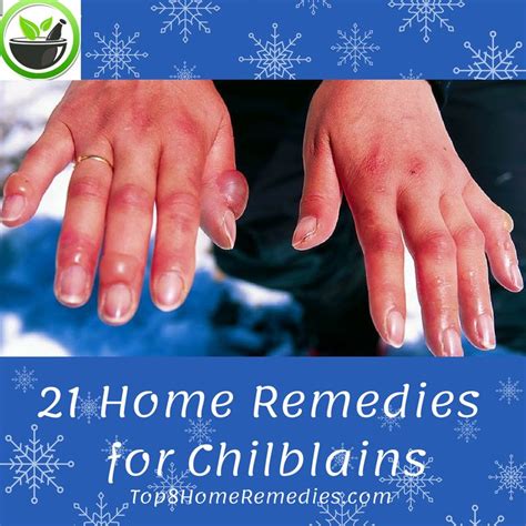 Chilblains Most Often Affects People Who Live In Cold Climates Skin