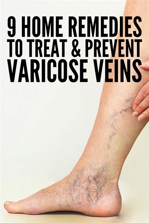 How To Get Rid Of Varicose Veins 9 Home Remedies That Work Varicose