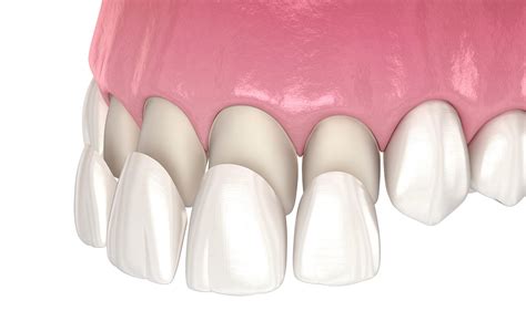 porcelain veneers brisbane — queensland prosthodontics dr michael brandon lewis brisbane