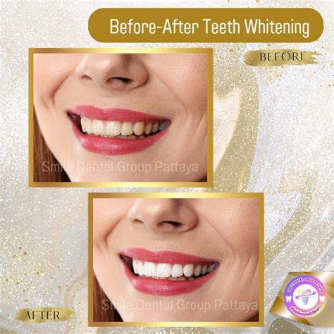 Teeth Whitening Central Pattaya Dental Center